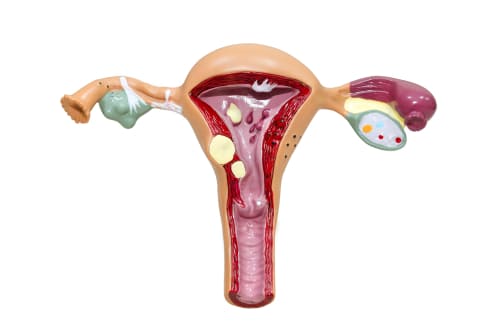 Cirugía para prolapso uterino (utero-pexia por laparoscopia)